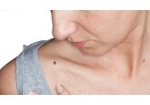 Skin cancer: Smartphone camera lens technology to be used to diagnose thousands of patients