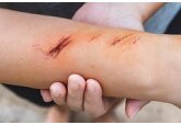 Разработан уникальный способ заживления ран электричеством
