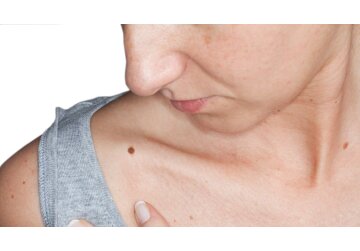 Skin cancer: Smartphone camera lens technology to be used to diagnose thousands of patients